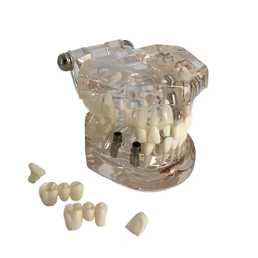 نموذج الراتنج للأسنان نموذج شفاف لفم الأسنان نموذج تعليم الأسنان أدوات الممارسة لمستلزمات طب الأسنان