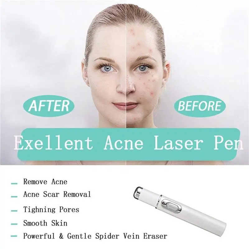 Hot Heath Blue Light Therapy Varicose Veins Treatment Laser Pen Soft Scar Wrinkle Removal Treatment Acne Laser Pen Massage Relax