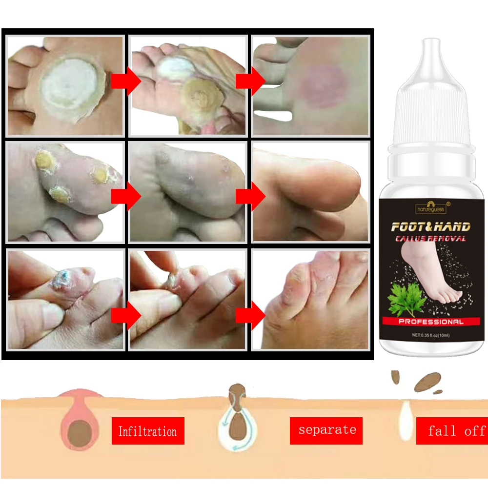 Natureguess Feet Exfoliating Pedicure Peeling Callus Corn Remover Foot Care Cream Dead Hard Skin Mask Peel Off Cleaner