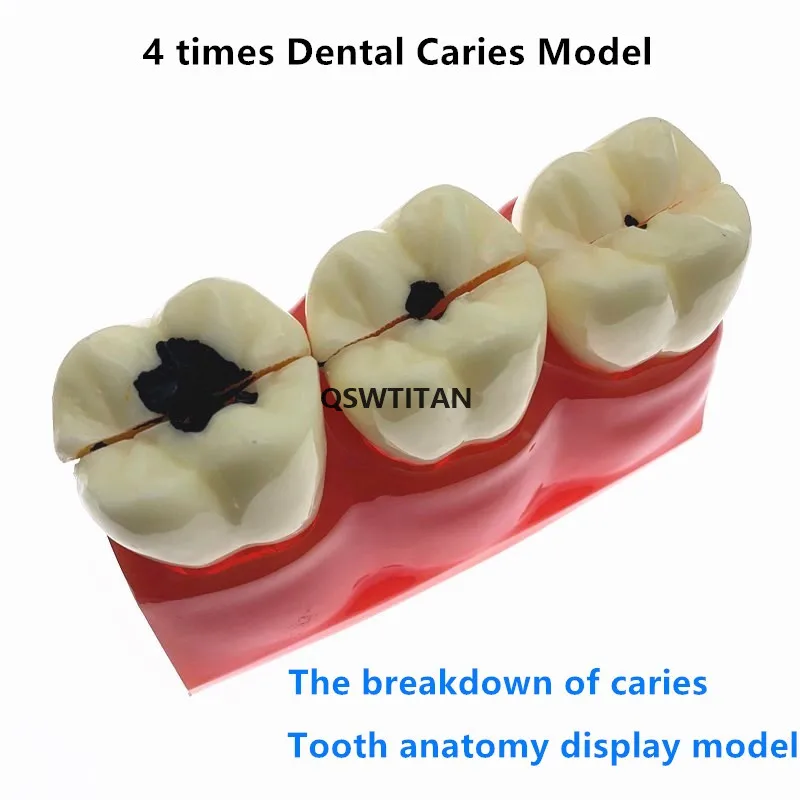 4Times Caries Models Caries teeth model for showing the progress of caries,fistula Teaching Research Model