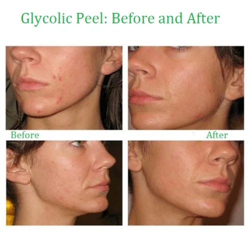 KIT 30% Glykol Säure Chemical Peel Neutralisieren, Pinsel Nachsorge Hautpflege