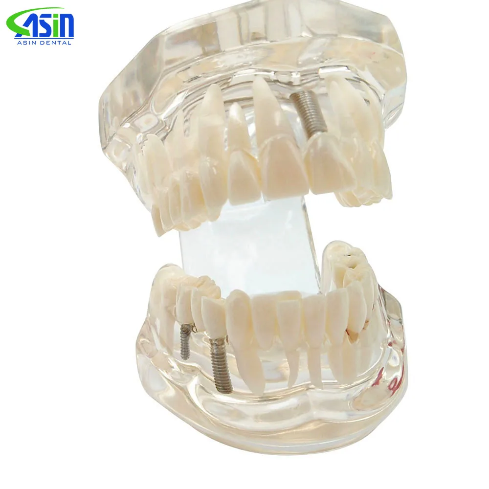 

Transparent Disease Teeth Model Dental Implant Teeth Model Dentist Dental Student Learning, Teaching, Research Communication