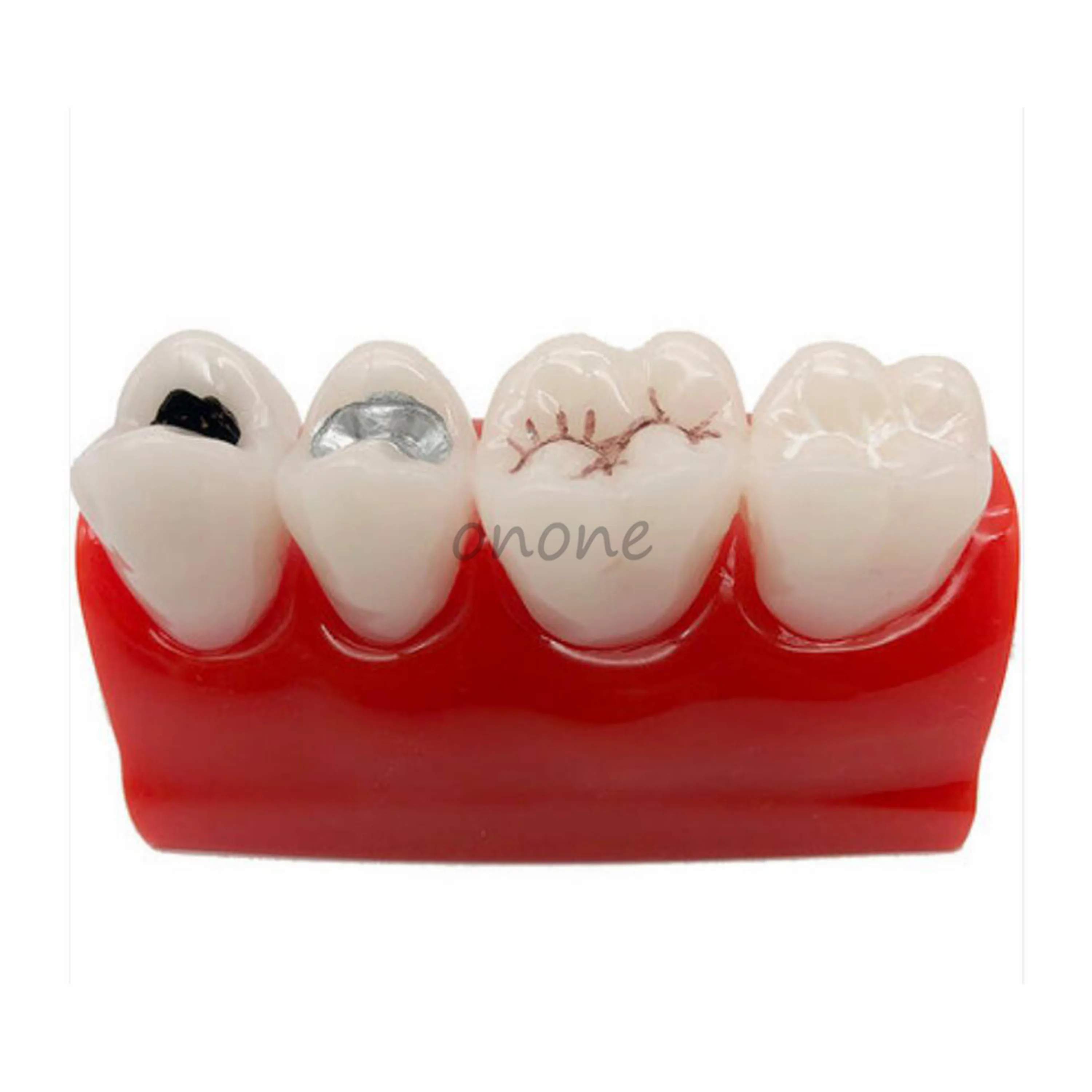 1pcs Pit and Fissure Closure Model Early Dental Caries Model Student Learning Teaching Model