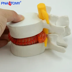 Modelo de enseñanza de hernia de disco Lumbar, pistola traumática, proveedores escolares, instrumentos médicos, anatomía de la columna vertebral humana, esqueleto AGRANDAR