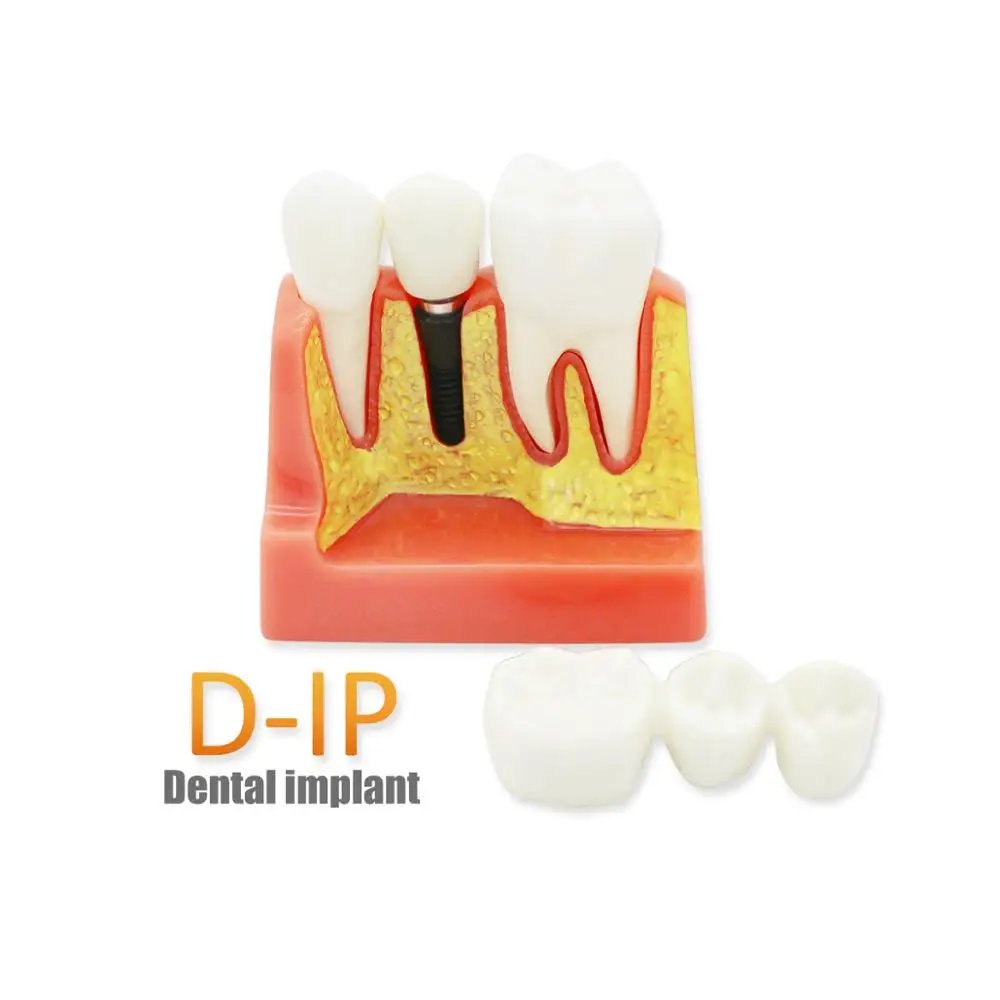 D-IP  Dental Materials Lab Teeth Model 6 Times Caries Comparation Study Models For Dentist Studying and Researching