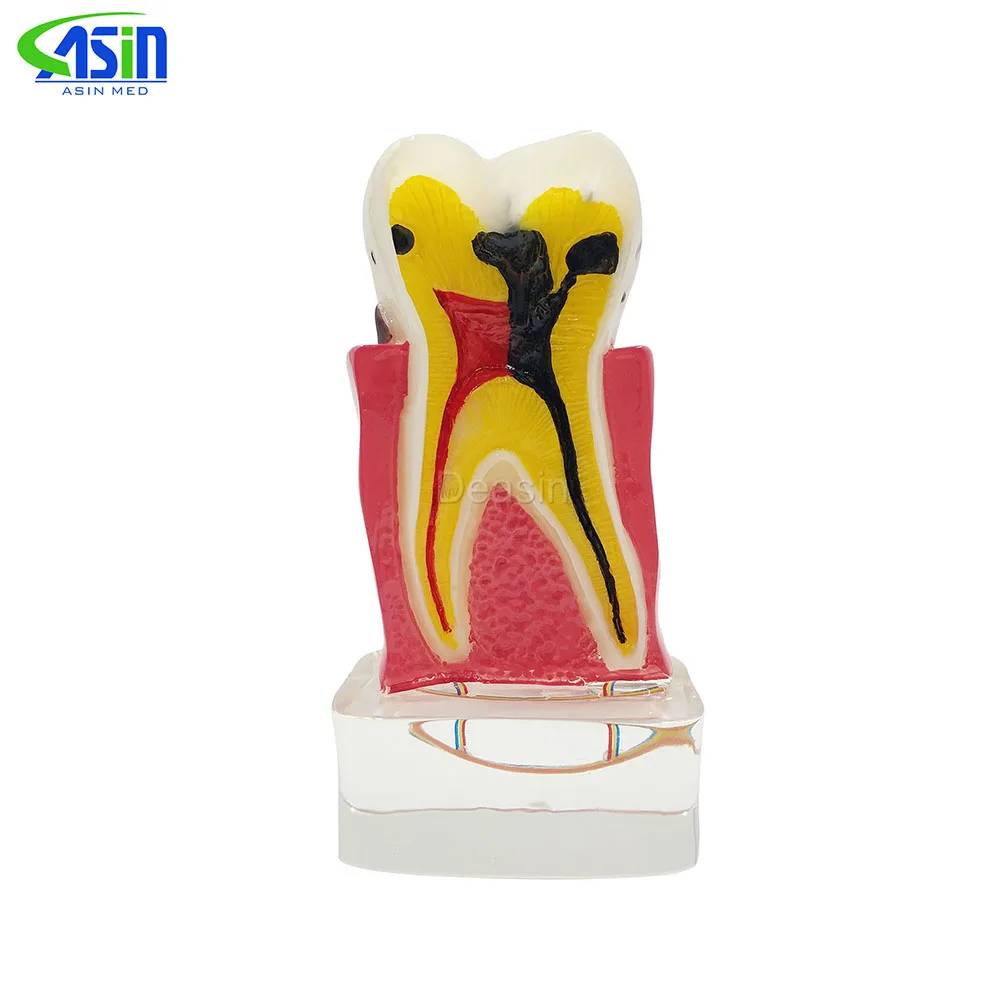 4:1 Dentist Dental Study Teach Tooth Model Teeth Disease Model