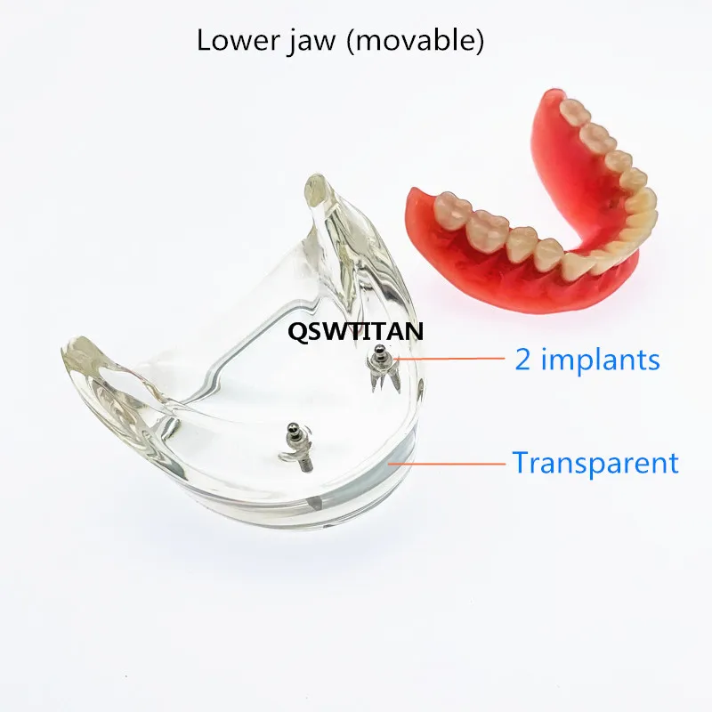 Dental Overdenture Teeth Model Removable Interior Mandibular with 2 Implant for Tooth Teaching Study