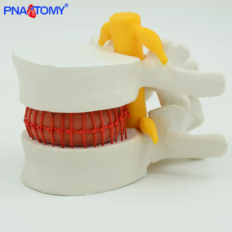 Dysk lędźwiowy przepuklina Model nauczania traumatyczne pistolet przybory szkolne przyrządy medyczne ludzki kręgosłup anatomia szkielet powiększ