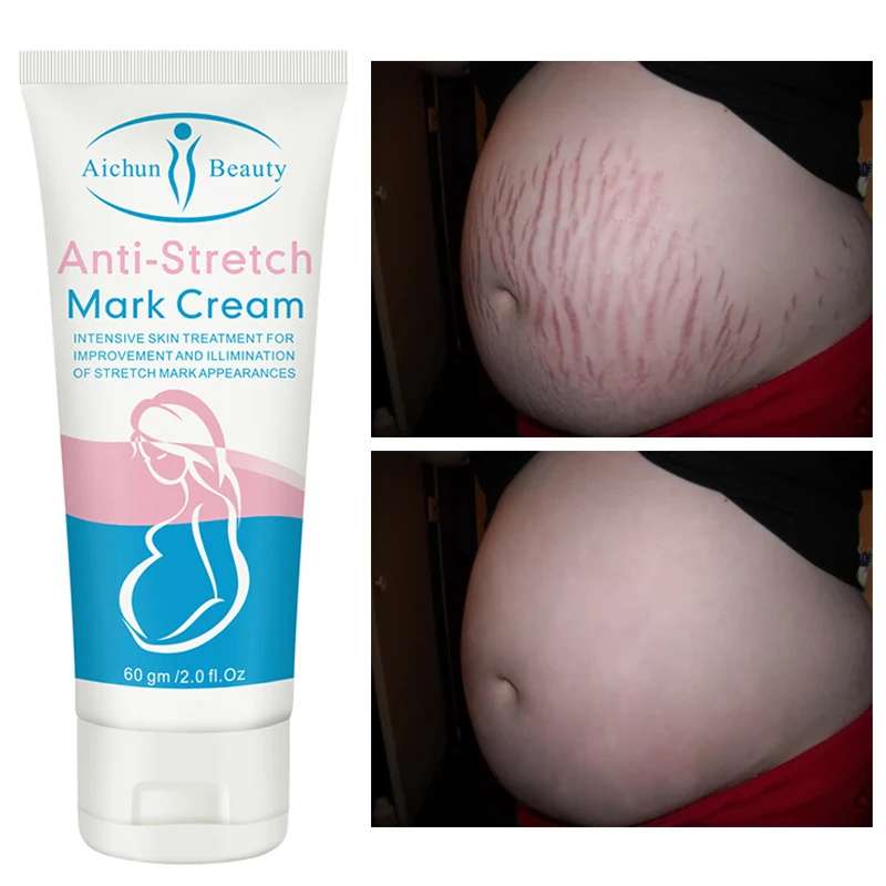 

Anti-Stretch Mark Cream Remove Stretch Marks Moisturizing Nourishing Remove Cellulite Improve Rough Brighten Skin Tone Skin Care