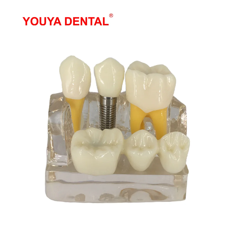 Dental Model Resin Transparent 4times Tooth Implant Model For Dentist Student Demonstration Teaching Module Oral Medical Product