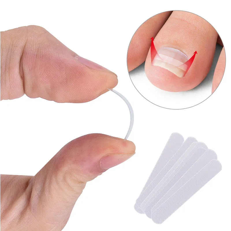 Outil de Correction des ongles incarnés, 10 pièces, Patch élastique de traitement des ongles incarnés, Clip de redressement, outil de pédicure