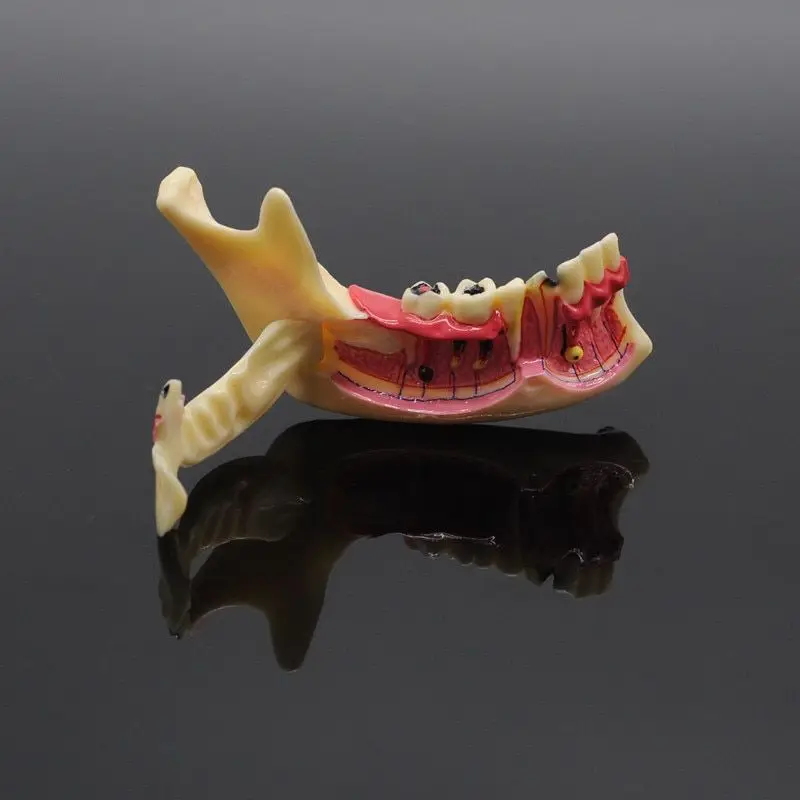 Dental Endodontic Treatment Model Anatomy of gums Dental Study Teach Teeth Model