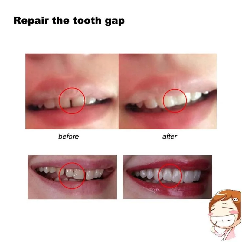Kit de reparo dental temporário para dentaduras e próteses dentárias, cola sólida, ferramenta de higiene oral, instrumento de clareamento dental,
