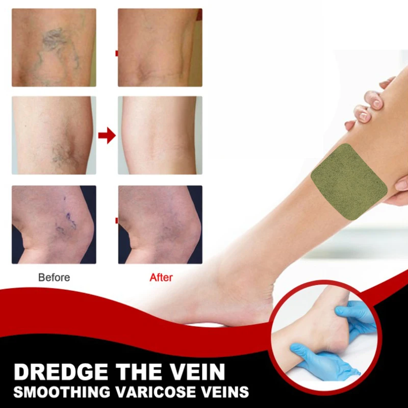 12Pcs Herbal Varicose Veins Detox Healing Patch Vasculitis Phlebitis Spider Patch Varicosity Angiitis Removal Medical Plaster