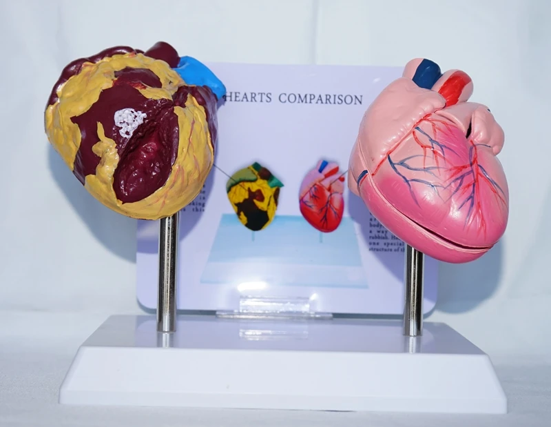 

Human Anatomy Smoking and Normal Heart Comparison Medical Teaching Model