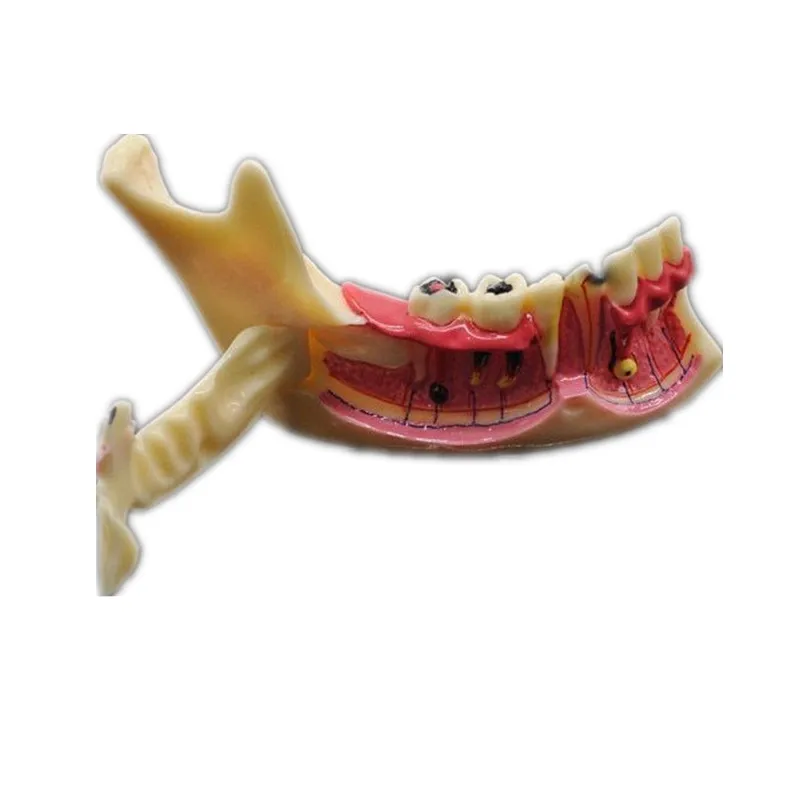 Dental Endodontic Treatment Model Anatomy of gums Dental Study Teach Teeth Model