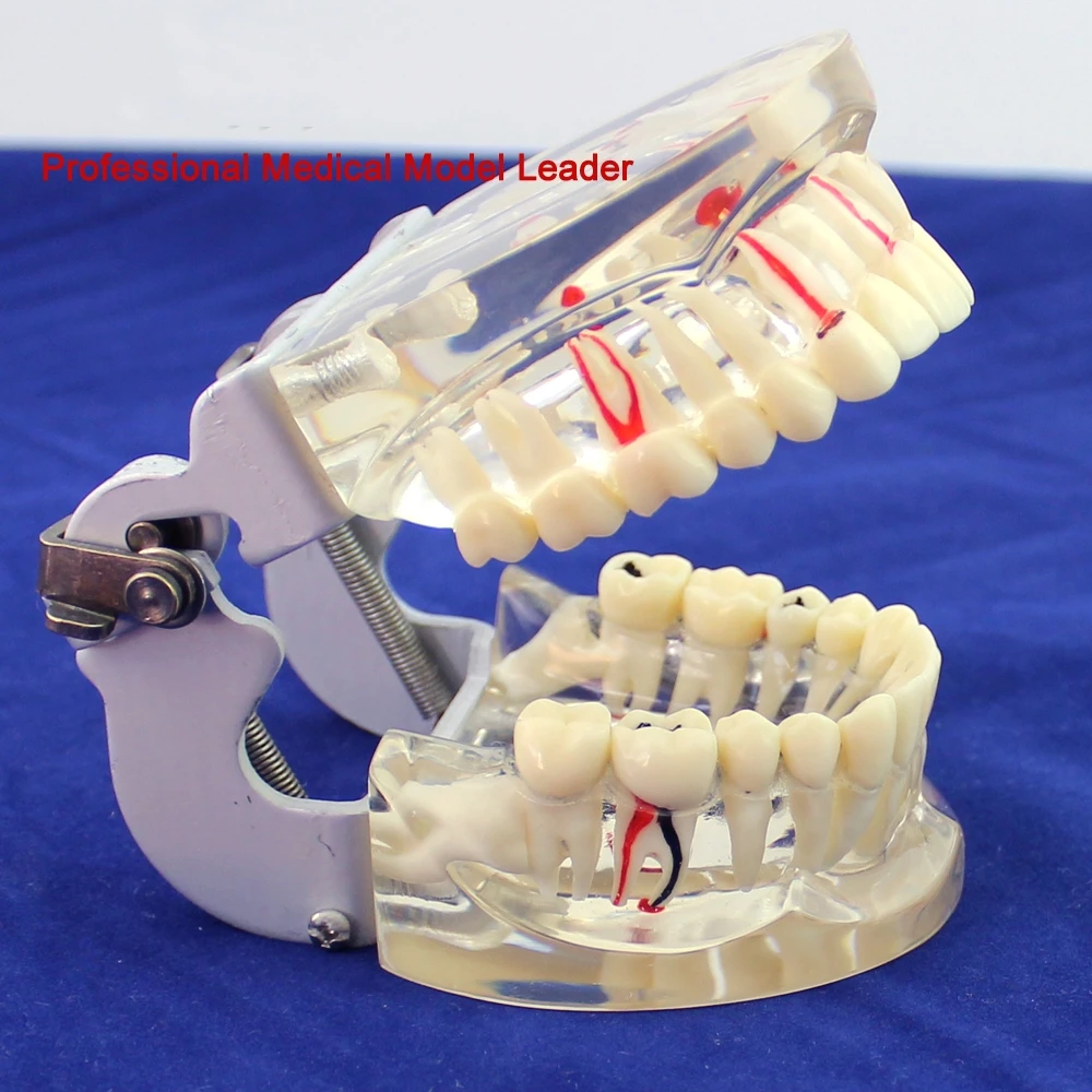 

Transparent adult comprehensive oral pathology model dental model periodontal disease dental caries demonstration model