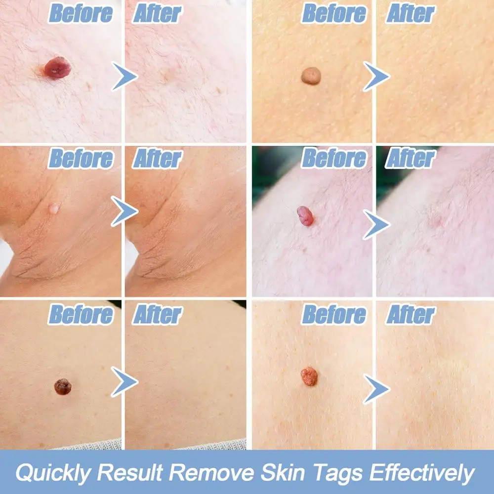 Lescolton Ⅱ Skin Tag Remover To Remover Wart Remover Mole Remover Skin Care Warts Removalผิวปานกลางหมวดหมู่BodyผลBand