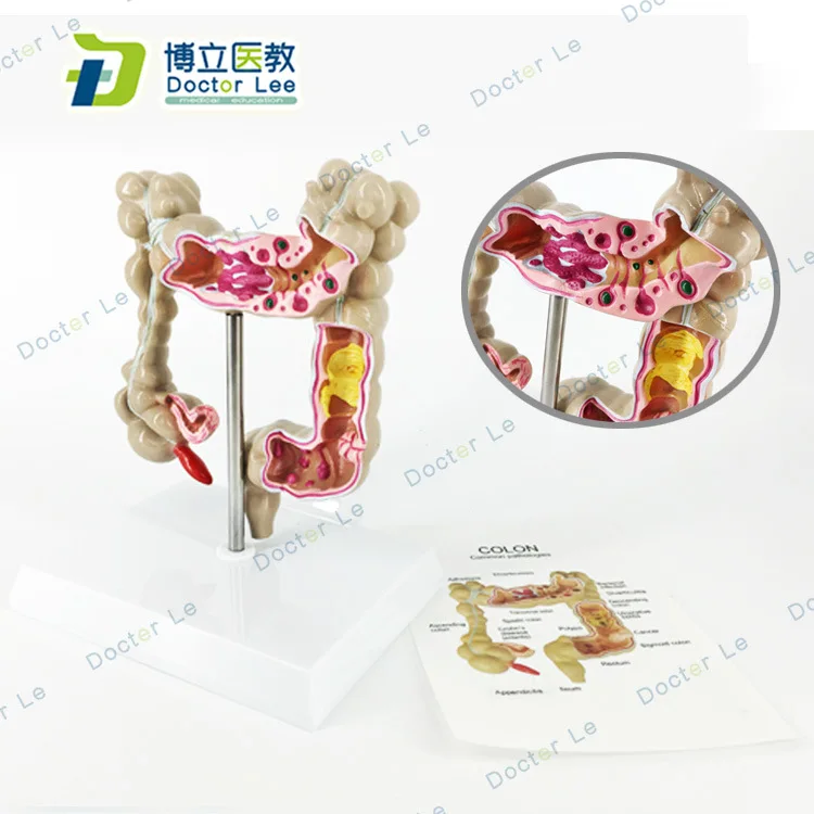 

1/2 Life Sized Medical Human Anatomy Intestine Model Colon Disease Model Anorectal Gastroenterology Anatomical Model