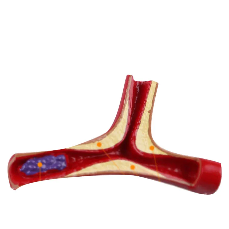 Teaching model of thrombosis in elderly heart model of coronary cardiovascular arteriosclerosis model