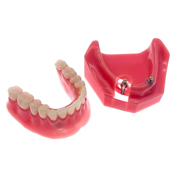 

Teeth Model 2 Implants Tooth Model Dental Inferior Implant Overdenture Teaching Model