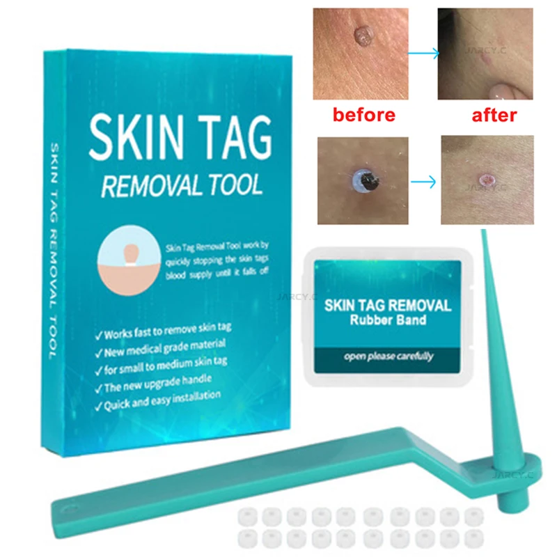 Micro Band Tag Removal Kit Papillomas Treatment Face Care Mole Wart Tool Cleaning with Skin Tag Removal Rubber Ring Home Use