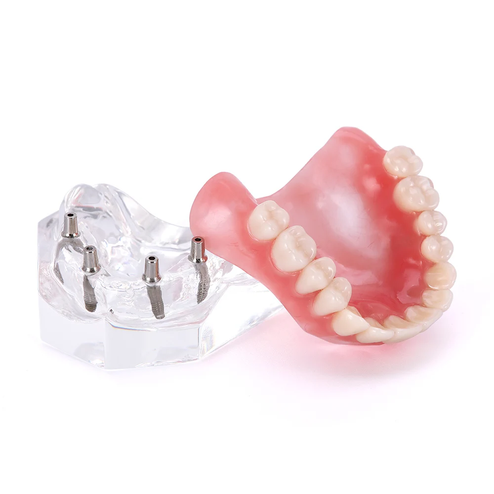 Modelo Mandibular Dental Removível com Implante, Dentes Overdenture, Dentes Superior e Inferior, Dente Ensino e Estudo