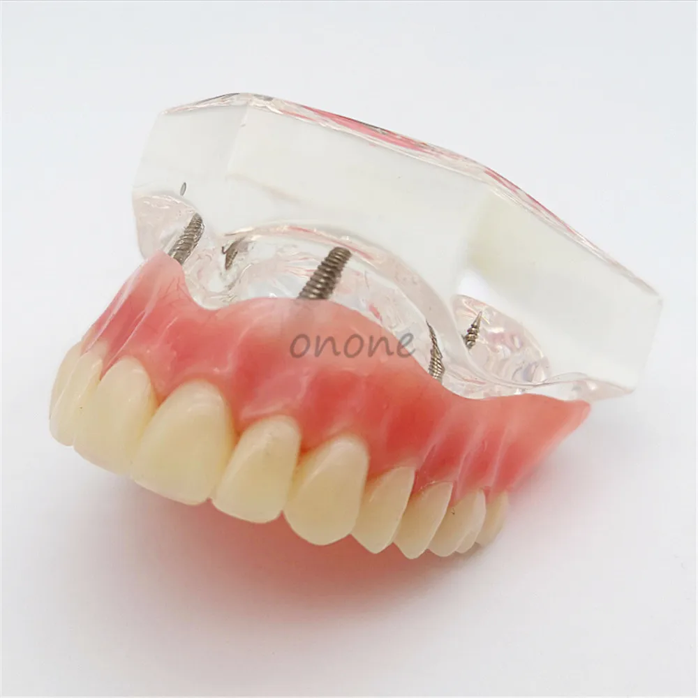 1pcs Dental Upper Overdenture Teeth Dental Implant Teeth Model Overdenture Restoration With 4 Implants