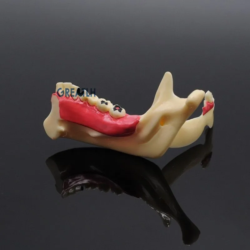 Dental leczenie endodontyczne Model anatomia dziąseł badanie stomatologiczne naucz Model zębów