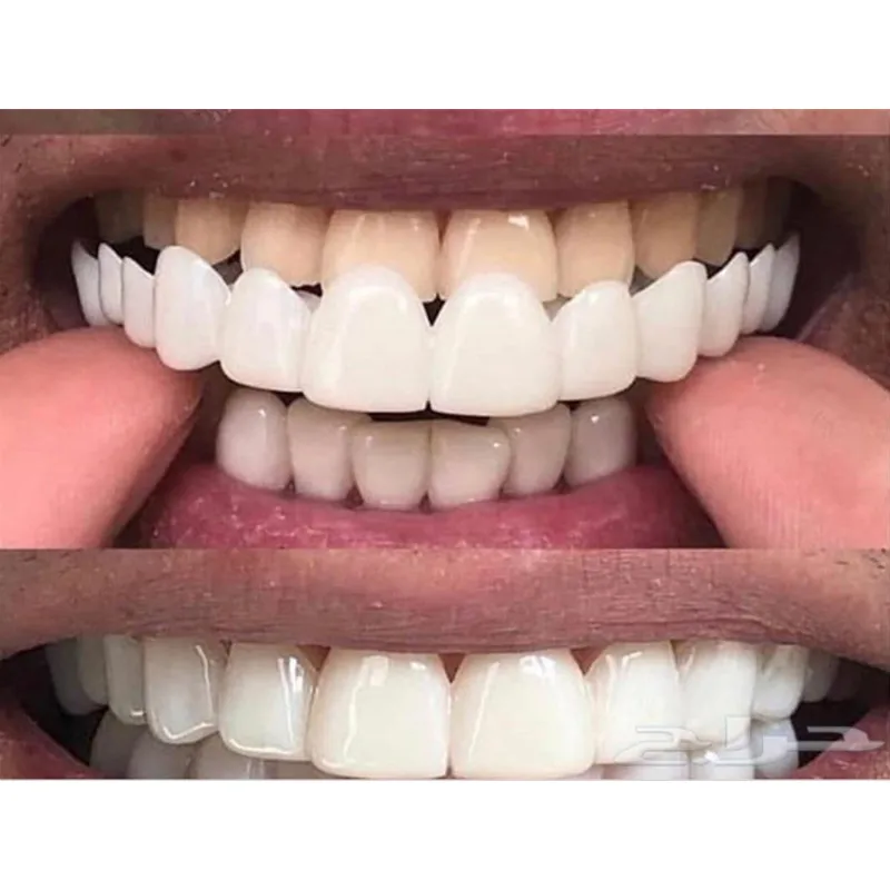 Dental snap sorriso dental superior falso dentes capa perfeita sorriso folheados conforto ajuste flex branqueamento dentadura aparelhos