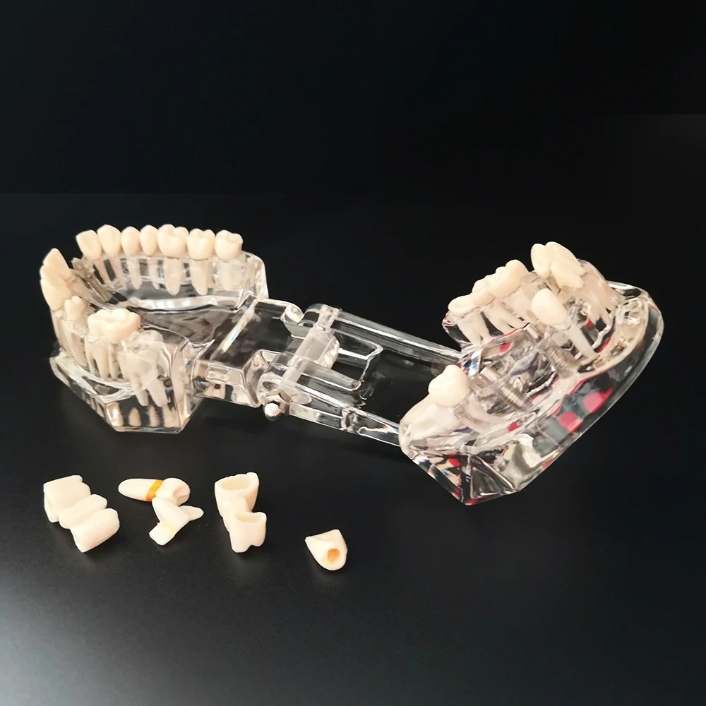 Neues Dentalmodell für Zahnimplantate, Restaurationsbrücken, Lehrmaterial für Medizinische Wissenschaft, Krankheiten, Zahnärzte und Zahnmedizinprodukte – Detail 4