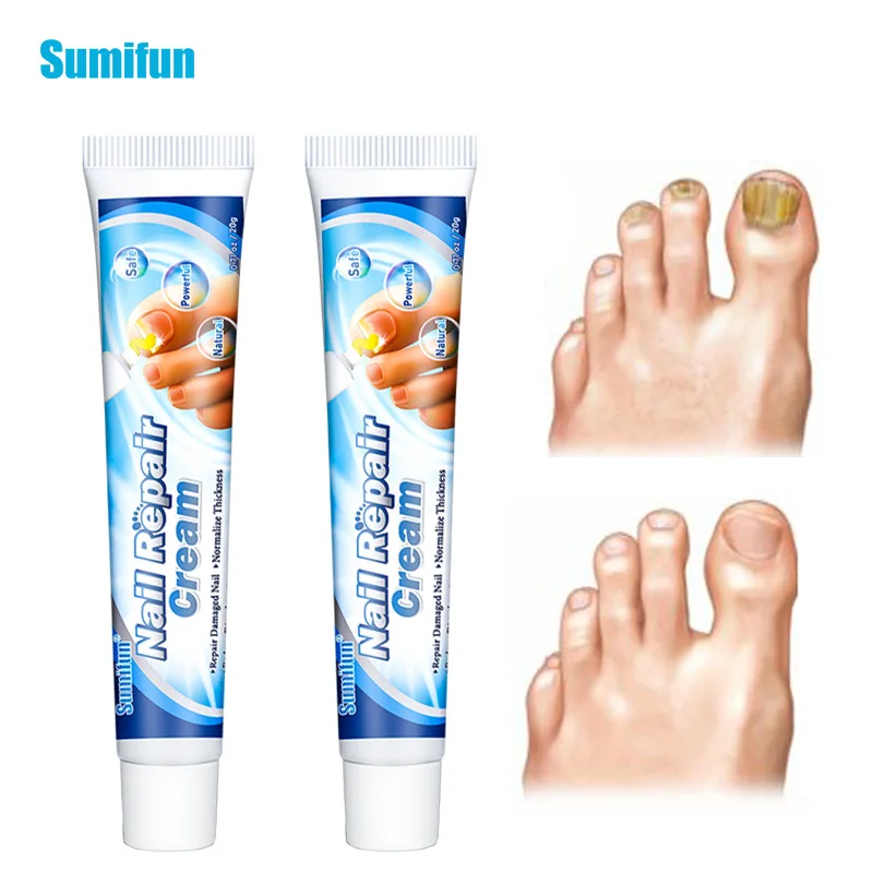 

Sumifun 20g Fungal Nail Repair Cream Finger Toe Onychomycosis Treatment Anti Fungus Infection Ointment