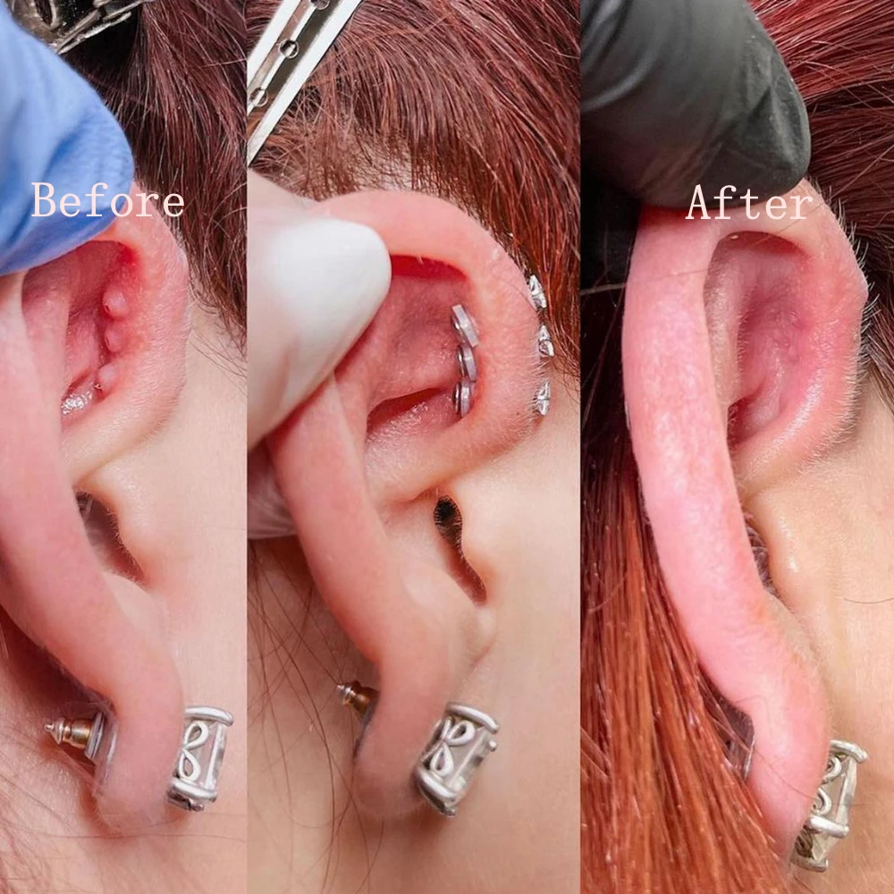 ZS 6-200 teile/los Silikon Piercing Heilung Scheiben Set Flexible Anti Hyperplasie Flache Klare Medizinische Silikon Disc 3/5/7/9 MM – Detail 2