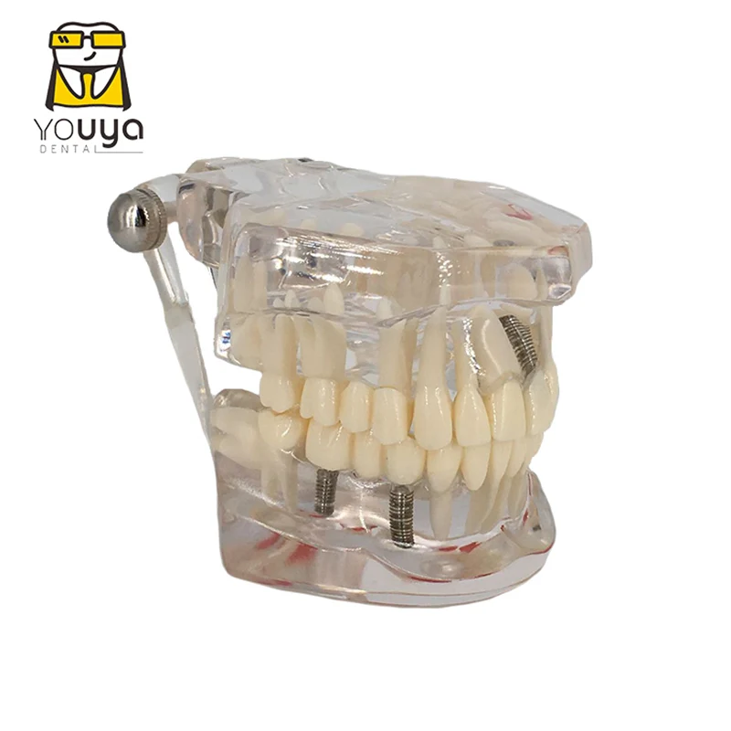 Transparent Disease Teeth Model Dental Implant Teeth Model Dentist Dental Student Learning, Teaching, Research Communication