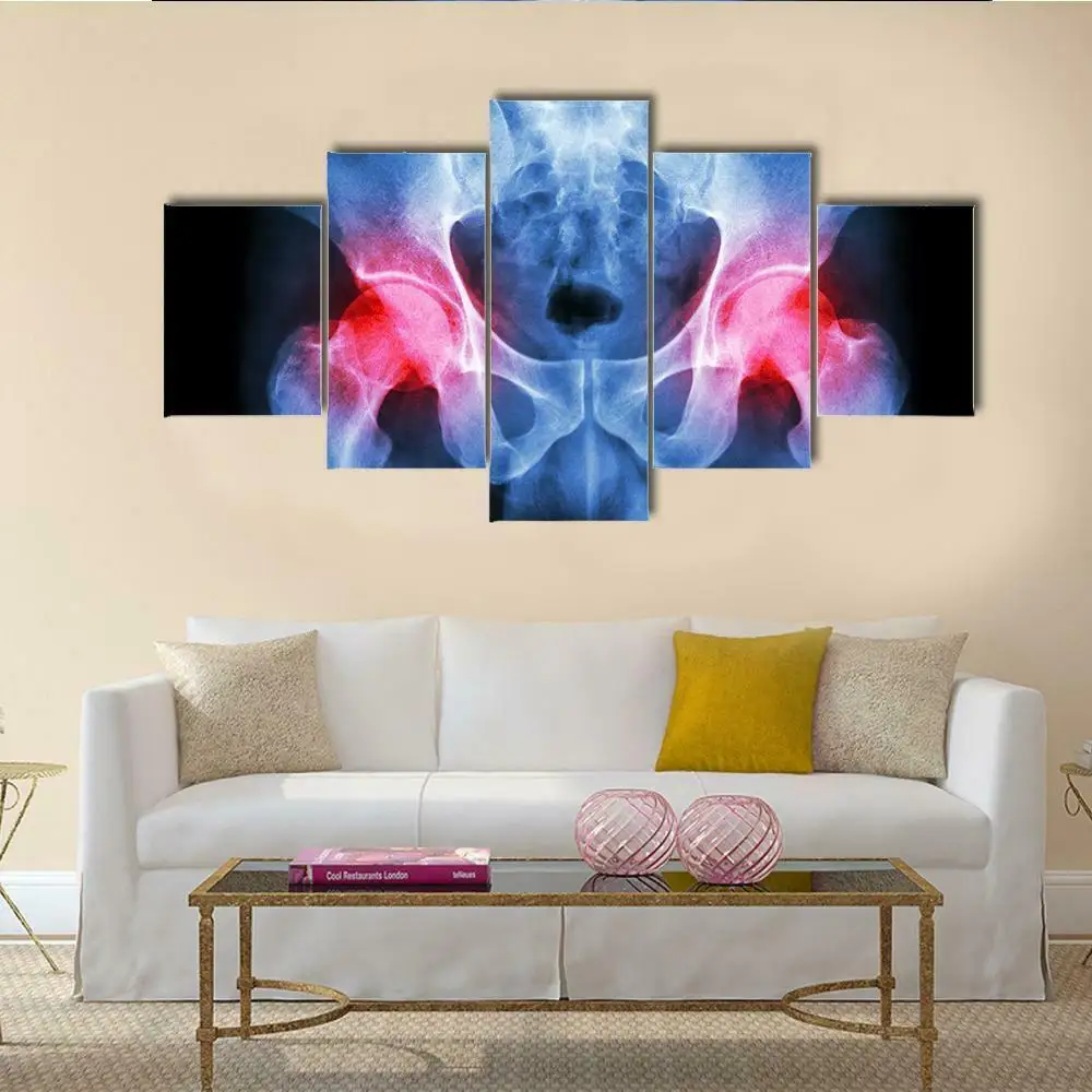 

Human's Pelvis Arthritis X-ray 5 Panel Canvas Picture Print Wall Art Canvas Painting Wall Decor for Living Room Poster No Framed