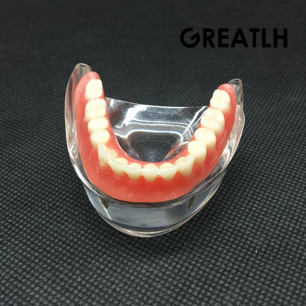 Nha Khoa Overdenture Nội Thất Mandibular Răng Hàm Dưới Mẫu Mandibular Với Giả Phục Hồi Răng Nha Khoa Giảng Dạy Học