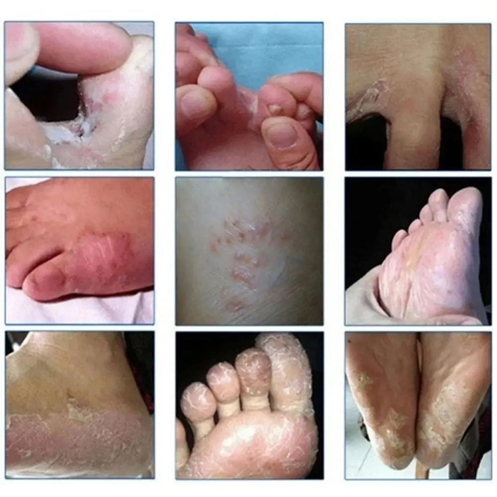 Fungal Infections Foot Bath Powder Feet Care  Foot odor Foot itch Athlete's Foot Foot Odor Sweat Itching Peeling Beriberi  Foot