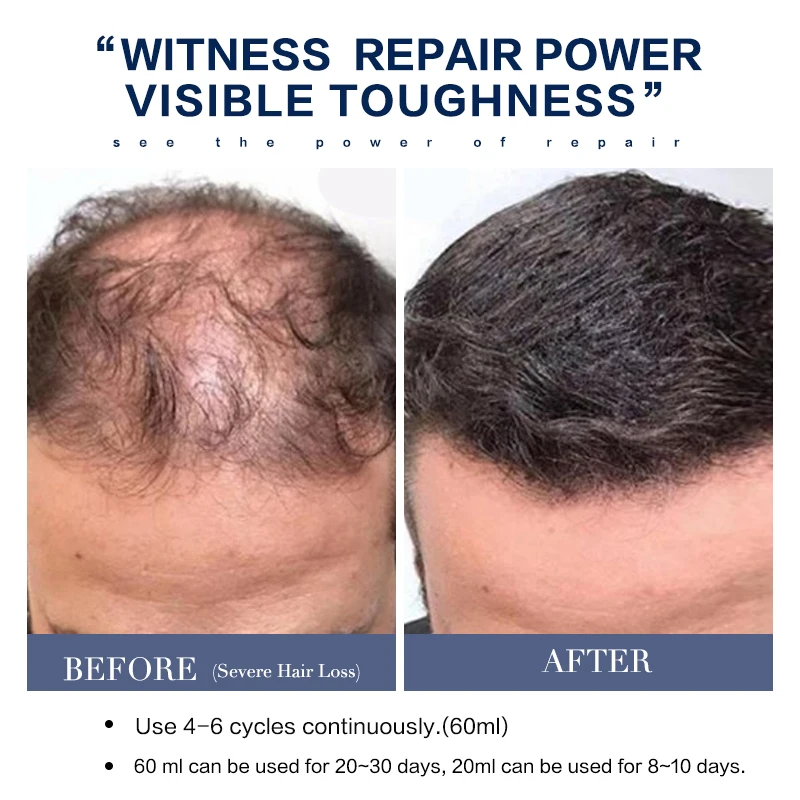 Hair Rapid Growth Spray for Men\'s Body and Chest and Eyebrows and Beard Thick Hair Treatment Loss Product 60ml and 20ml
