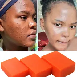 Sabão ácido kojic para manchas escuras e acne iluminação manchas escuras glutatione branqueamento sabão todos os tipos de pele