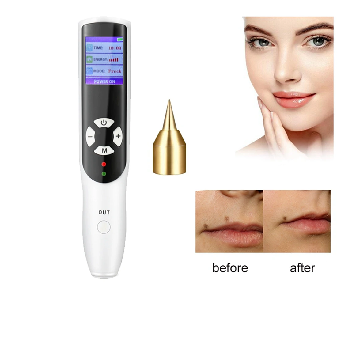 

2024 Ozone PAA Plasma Pen Wart Freckle Removal Fibroblast Eyelid Lifting Pen Skin Mole Dark Spot Remover Acne Treatment Machine