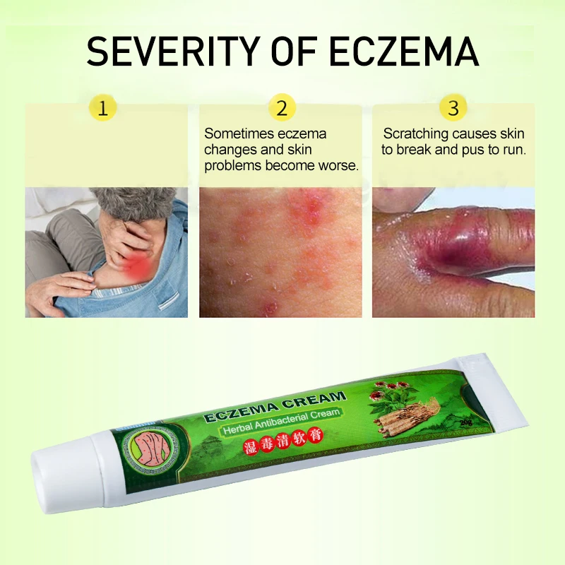 4Types Psoriasis Cream Antibacterial Antipruritic Dermatitis Eczema Urticaria Herbal Ointment Relieve Skin Itchy Medical Plaster