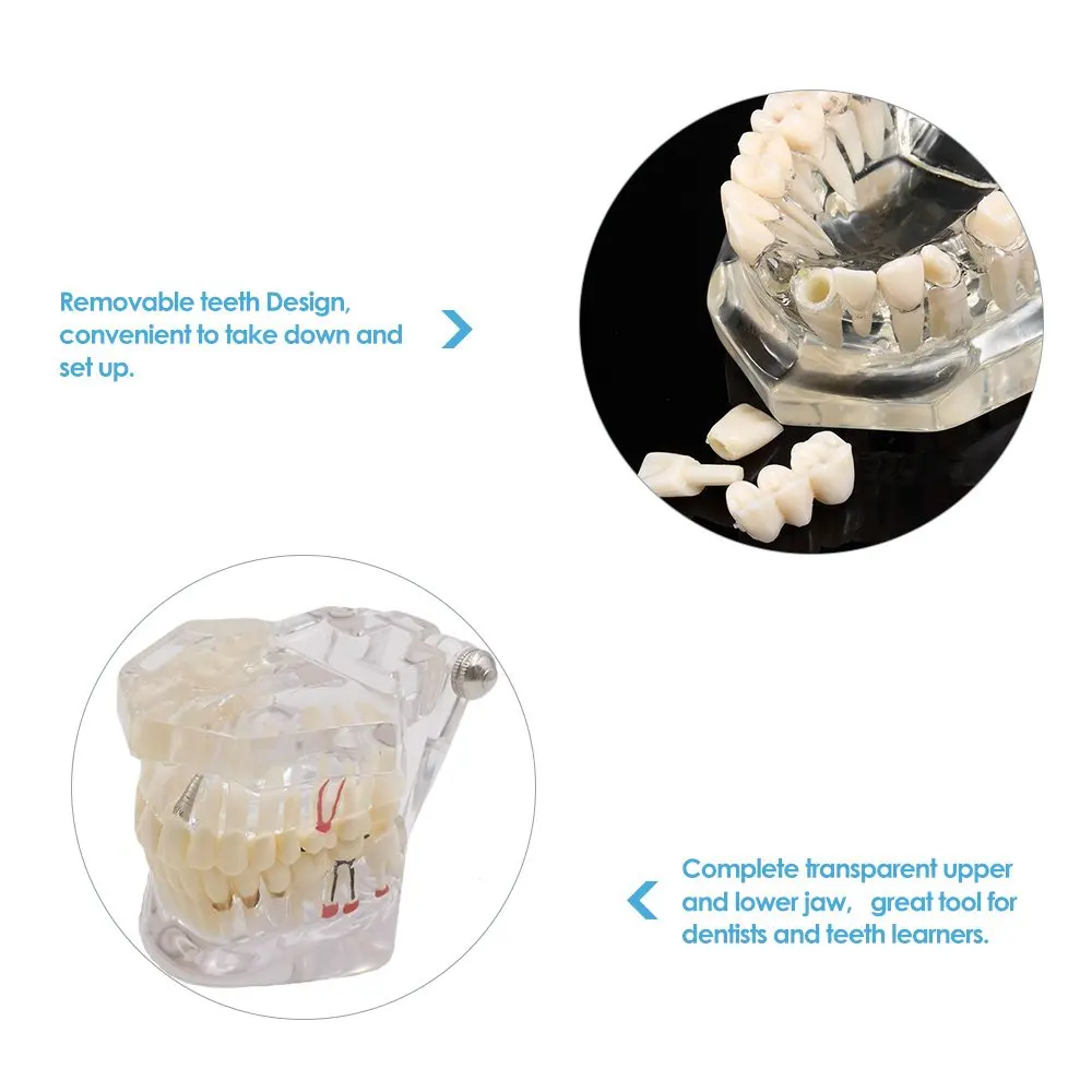 Transparent Disease Teeth Model Dental Implant Teeth Model Dentist Dental Student Learning, Teaching, Research Communication