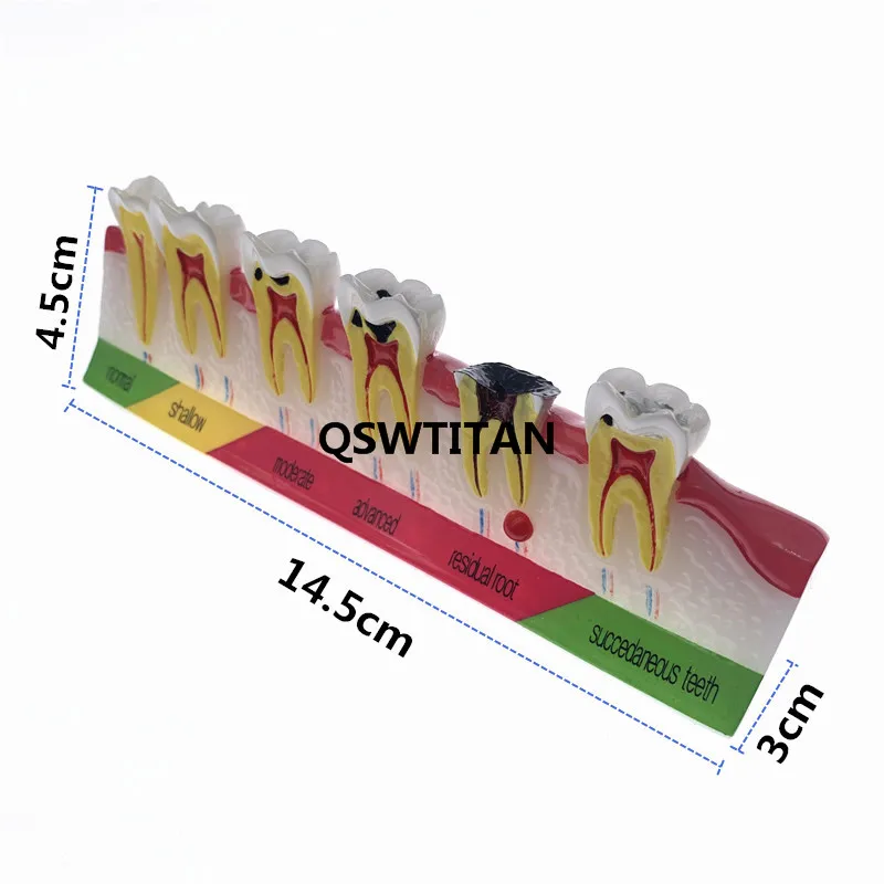 Dental caries classify model Tooth Model Demonstration Teach Study Dental teeth caries Evolution decayed tooth Analysis Model