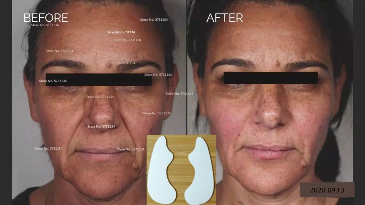 

Instant Nasolabial Folds Patch Deep Wrinkle Line Smile Lines Treatment Face Neck Eye Facial lift Tapes V Shape Tape Anti Aging