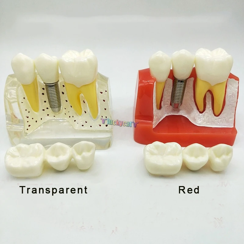 1Pc Dental Teach Implant Analysis Crown Bridge Removable Model Dental Demonstration Teeth Model