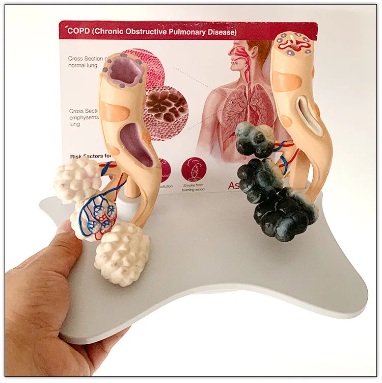 Human Smoke Healthy Alveolar Model Dissection Trachea Lung Pathology Magnify The Alveolar Structure