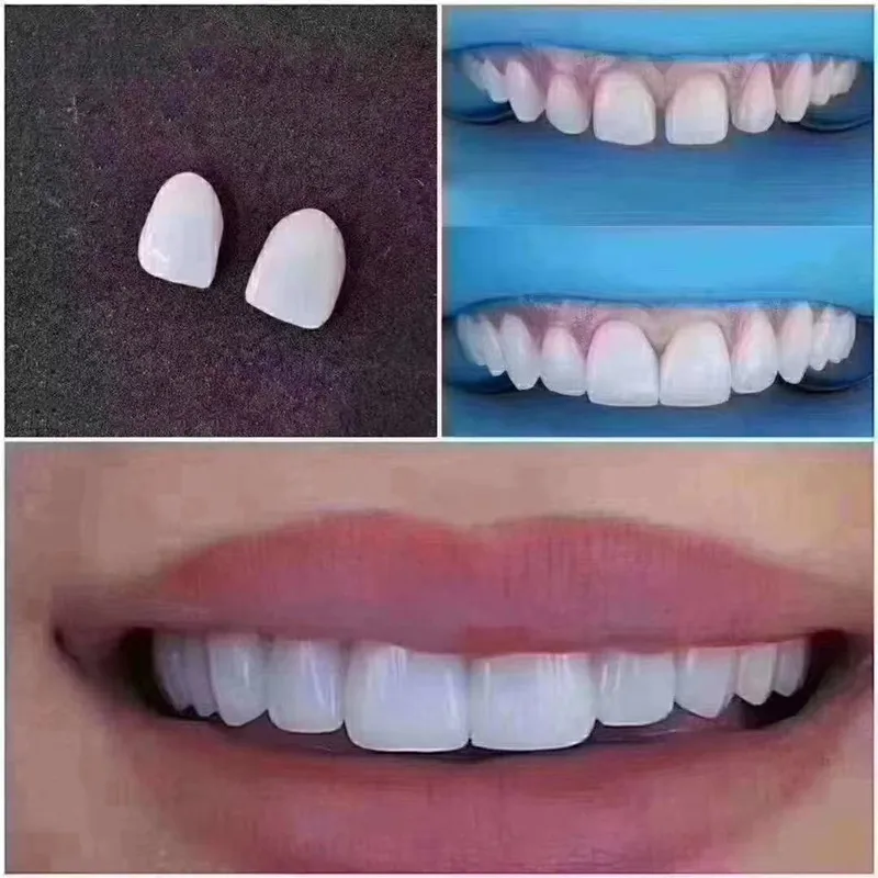 Nr 41 #2 sztuk zęby fornir wybielanie zębów Dental ceramiczne kompozytowe porcelany klinika przednia jasna biała LOWRE średnie małe