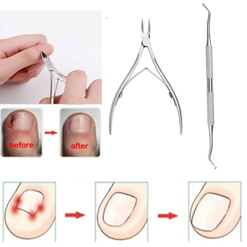 Ingrown Toenails Pedicure Foot Care Tool Nail Correction Clipper Cutters For Orthotic Acronyx Dead Skin Remover Podiatry