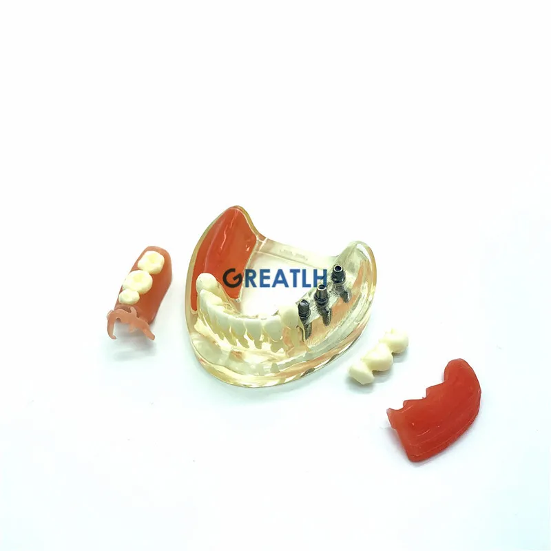 Dental Demonstration Model Teeth for Implant Restoration Teeth Model Removable Bridge dentist studying patience model