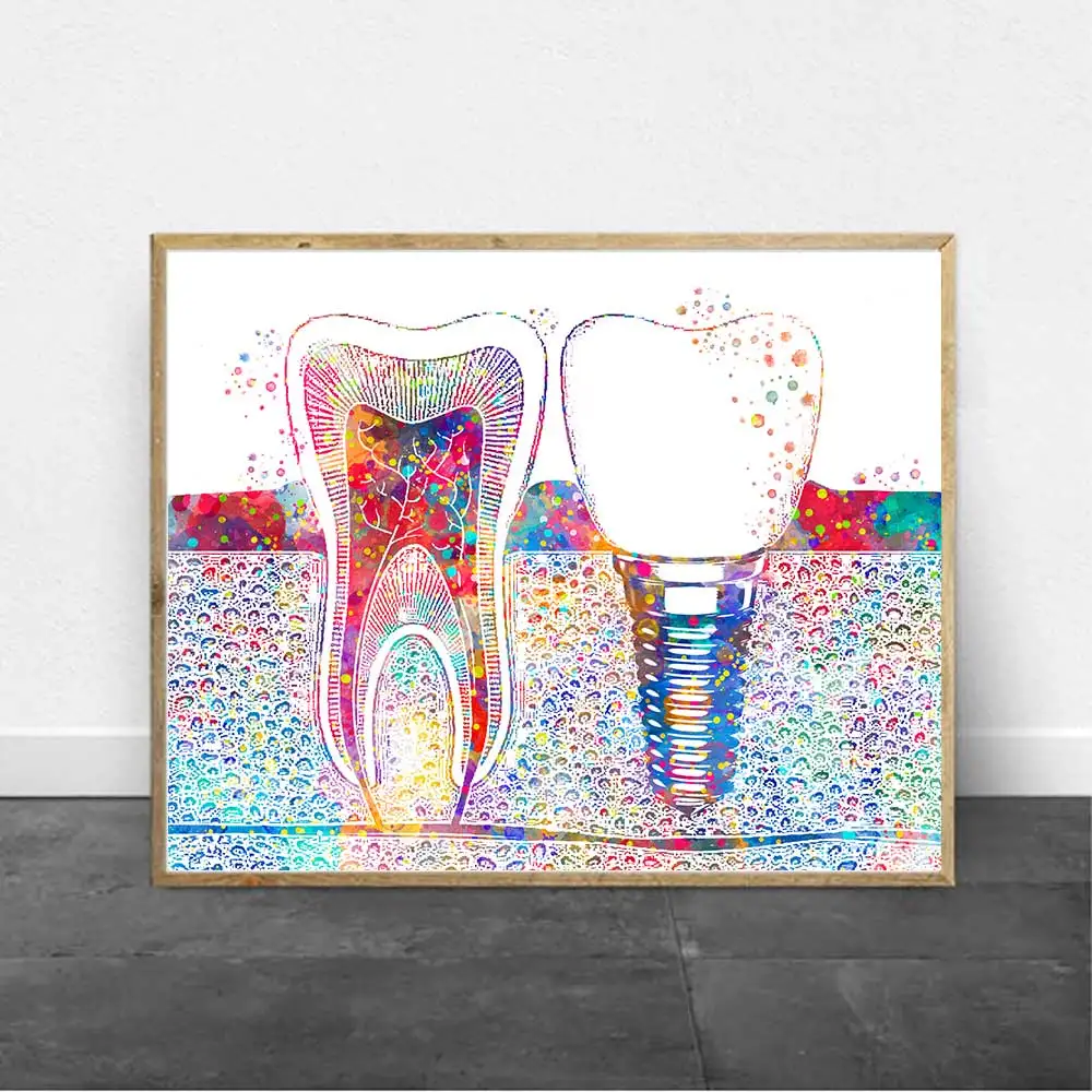 Dental Art Picture Tooth Implant Canvas Print Dentist Wall Art Painting Medicine Hygienist Poster Tooth Clinic Decor